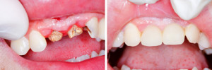 Frontal teeth needing medical attention - before and after treatment.