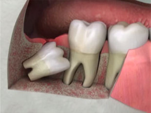 widsom-teeth-impacted