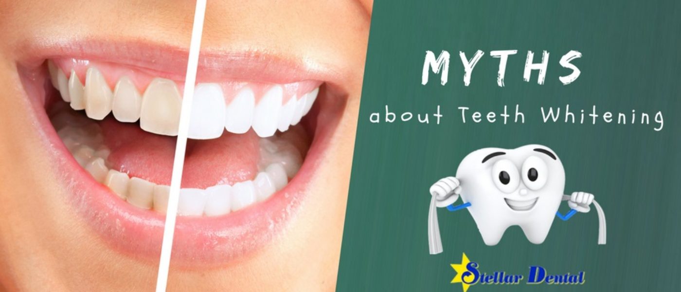 Top Five Myths about Teeth Whitening