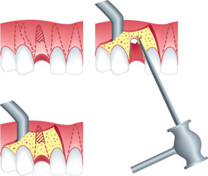 Endodontics