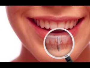 dental implant