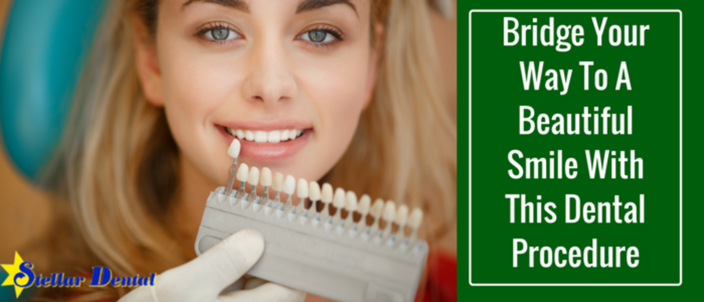 Dental Bridges: Your Way To A Beautiful Smile