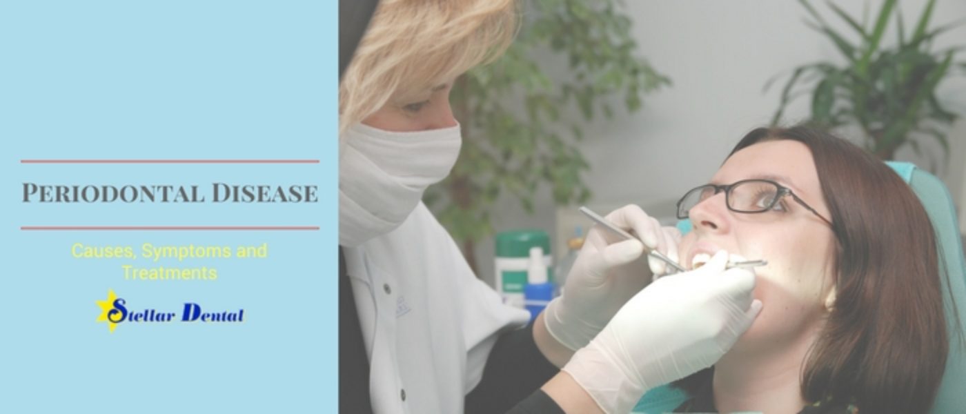 Periodontal Disease: What Are the Causes, Symptoms and Treatments