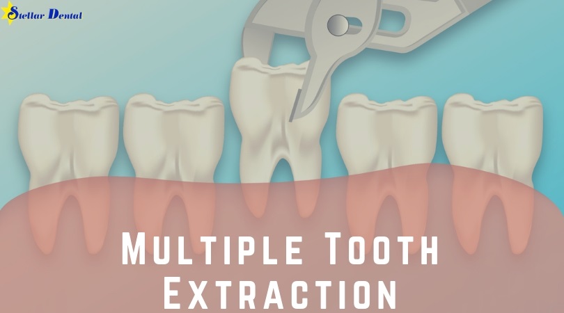Multiple Tooth Extractions in Hyattsville & Silver Spring, MD | Stellar ...