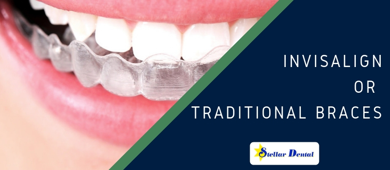 invisalign or traditional braces